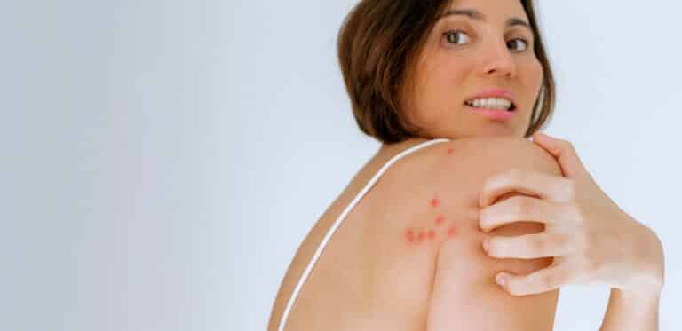 Bed Bug Bite